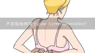 芦荟胶如何用于guise hyperpigmentation?